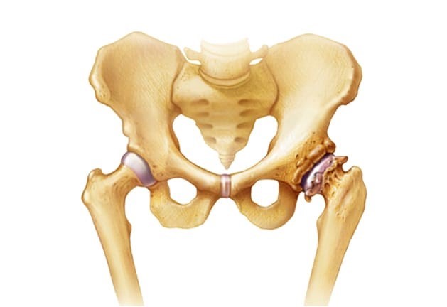 Osteoathritis in the hip bone