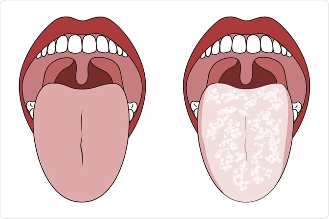 candidiasis